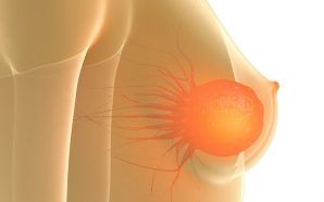 Metastatic Breast Cancer Treatments