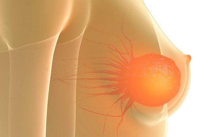metastatic breast cancer treatments