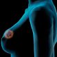 the types of breast cancer