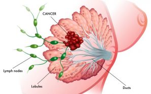 Stages of Breast Cancer