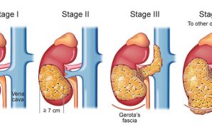 metastatic renal cell carcinoma treatment, renal cell carcinoma diagnosis, metastatic renal cell carcinoma, metastatic renal cell carcinoma treatments, What is Renal Cell Carcinoma Cancer?, metastatic renal carcinoma treatments, metastatic renal cell carcinoma diagnosis, renal cell carcinoma treatment, renal cell carcinoma, alternative kidney cancer treatment, advanced kidney cancer treatments, kidney cancer survival rates, treatment advanced kidney cancer, metastatic kidney cancer treatments, treatment for metastatic kidney cancer