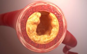 treatment pulmonary embolism, pulmonary embolism treatment, pulmonary embolism treatments, treatments for pulmonary embolism, treatment for pulmonary embolism, pulmonary embolism info