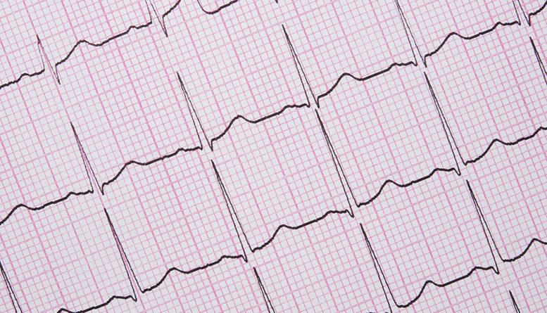 Myocardial Infarction