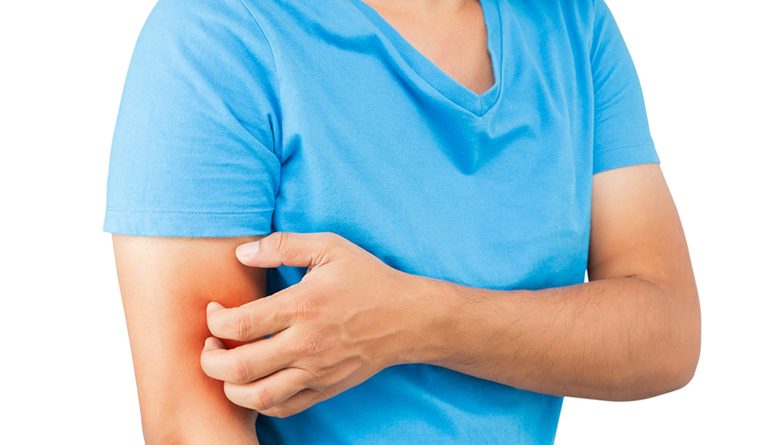atopic eczema treatments