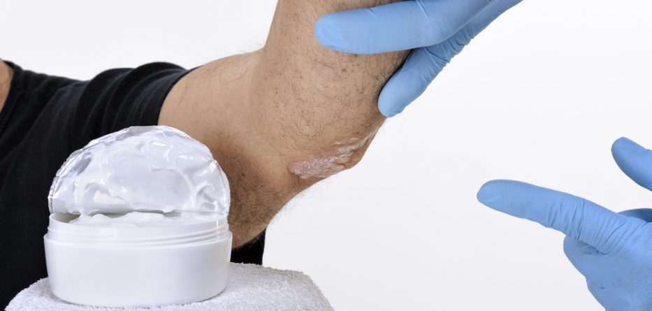 eczema ointment