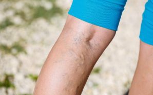 Varicose Eczema