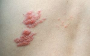 valtrex shingles treatment