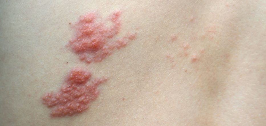 valtrex shingles treatment