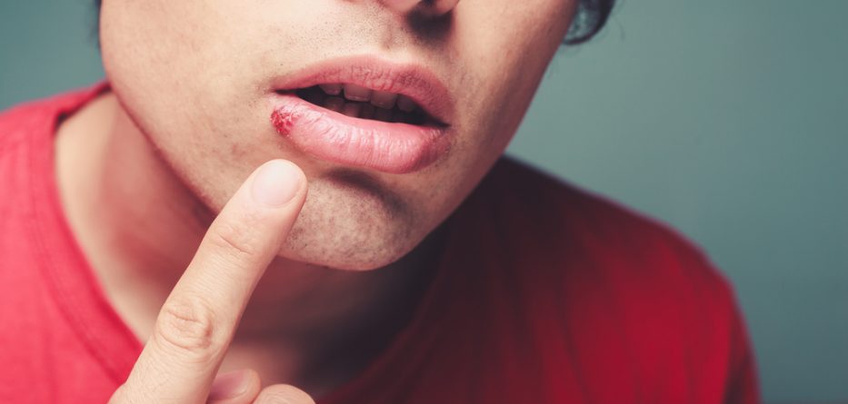 Herpes Medication
