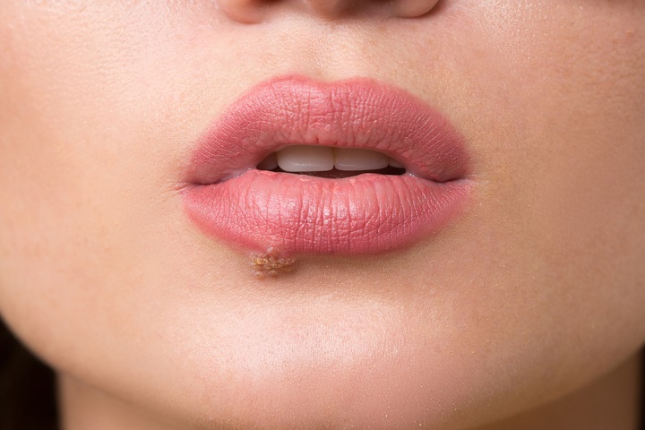 cure herpes